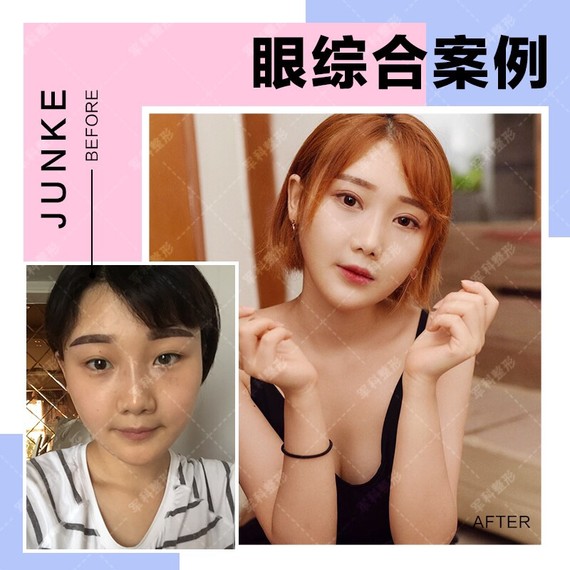 怎么判断眼睛是否存在上睑下垂?