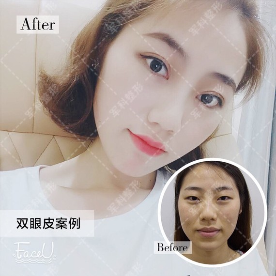 怎么判断眼睛是否存在上睑下垂?