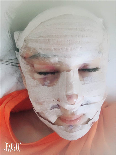 沈阳盛京尚美王超自体脂肪填充怎么样?好不好?案例分享