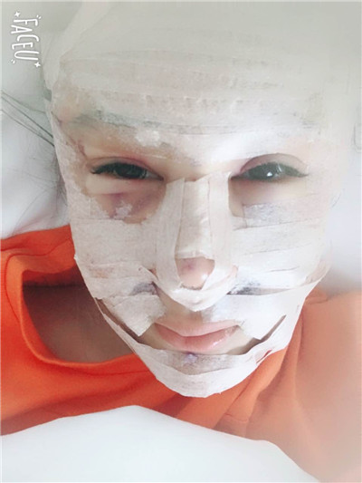 沈阳盛京尚美王超自体脂肪填充怎么样?好不好?案例分享