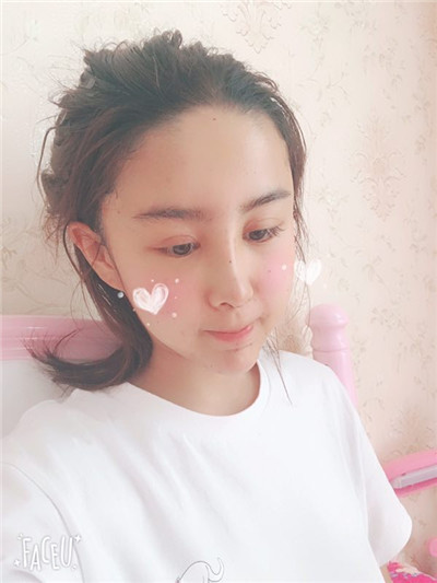 沈阳盛京尚美王超自体脂肪填充怎么样?好不好?案例分享