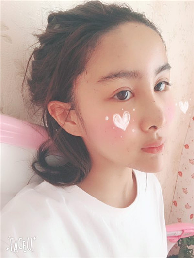 沈阳盛京尚美王超自体脂肪填充怎么样?好不好?案例分享