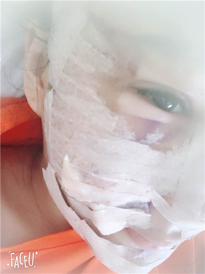 沈阳盛京尚美王超自体脂肪填充怎么样?好不好?案例分享