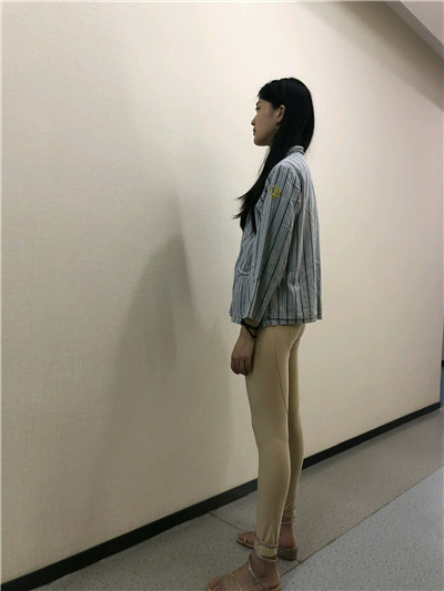 重庆瑞俪胡小义吸脂好不好?案例分享