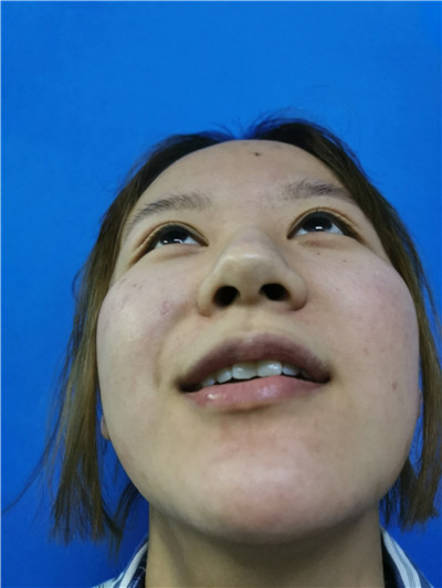 北京蜜邦驼峰鼻矫正怎么样?好不好?案例分享
