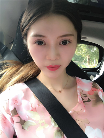 南京艺星汪树杰眼部综合怎么样?好不好?案例分享
