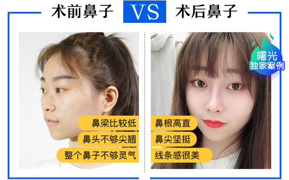 广州曙光蒋思军隆鼻怎么样?好不好?科普知识