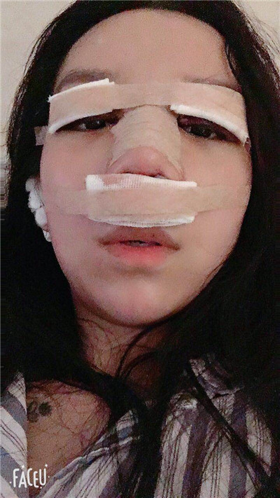 武汉华美马行眼部修复怎么样?好不好?案例分享