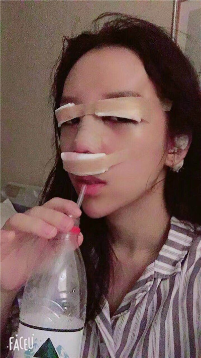 武汉华美马行眼部修复怎么样?好不好?案例分享