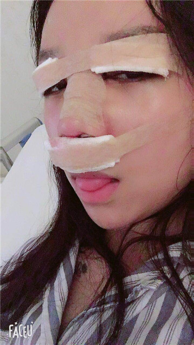 武汉华美马行眼部修复怎么样?好不好?案例分享