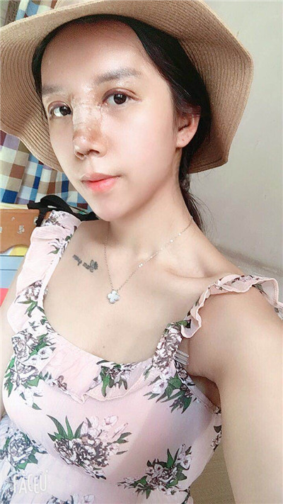 武汉华美马行眼部修复怎么样?好不好?案例分享
