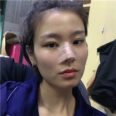 成都军大钟正强鼻部手术怎么样?好不好?案例分享