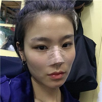 成都军大钟正强鼻部手术怎么样?好不好?案例分享