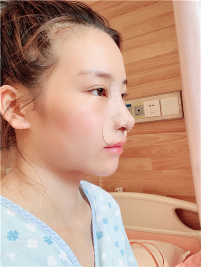 四川美莱雷状肋软骨隆鼻怎么样?好不好?案例分享