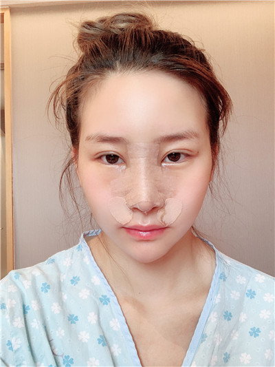 四川美莱雷状肋软骨隆鼻怎么样?好不好?案例分享