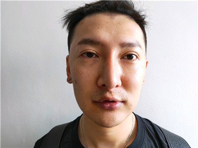 上海艺星童列健M唇手术怎么样?好不好?案例分享