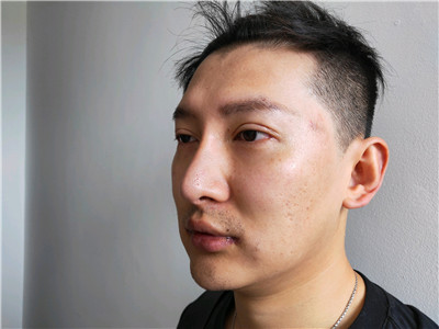 上海艺星童列健M唇手术怎么样?好不好?案例分享