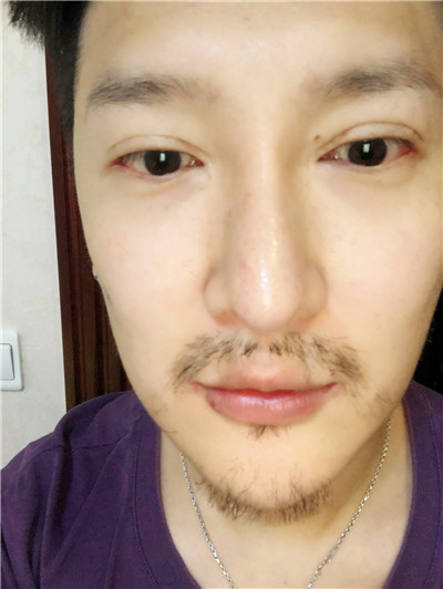 上海艺星童列健M唇手术怎么样?好不好?案例分享