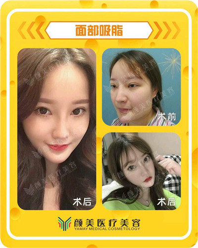 面部吸脂果好不好?