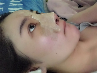 济南艺佳人高燕耳软骨隆鼻怎么样?好不好?案例分享