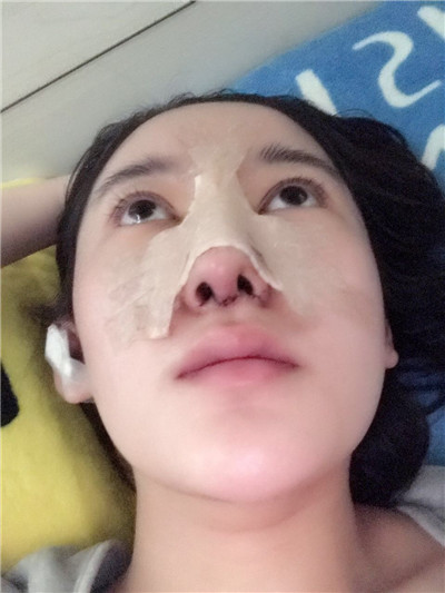 济南艺佳人高燕耳软骨隆鼻怎么样?好不好?案例分享
