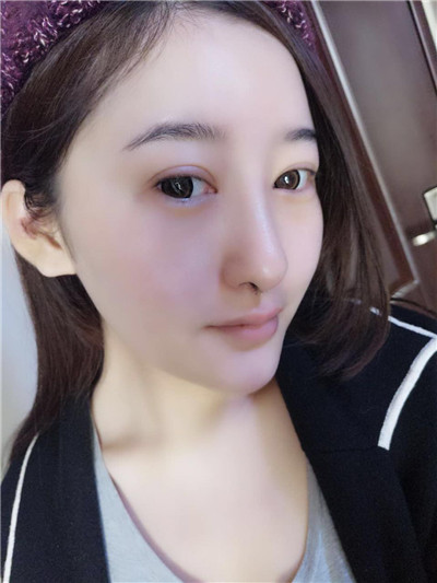 济南艺佳人高燕耳软骨隆鼻怎么样?好不好?案例分享