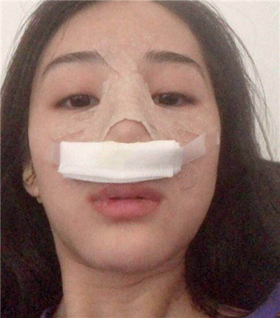 西安高一生张林宏硅胶隆鼻怎么样?好不好?案例分享