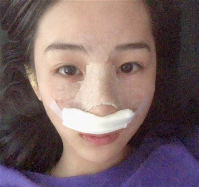 西安高一生张林宏硅胶隆鼻怎么样?好不好?案例分享