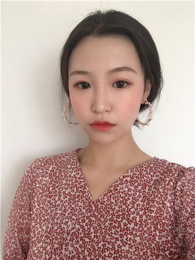 西安高一生张林宏硅胶隆鼻怎么样?好不好?案例分享