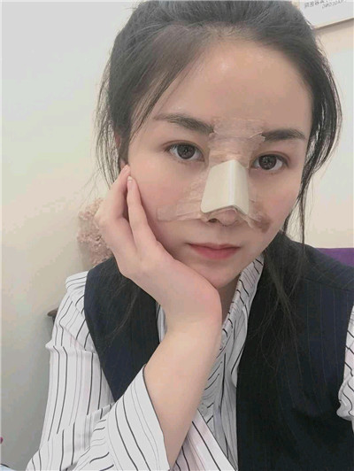 黑龙江超龙王海刚耳软骨隆鼻怎么样?好不好?案例分享