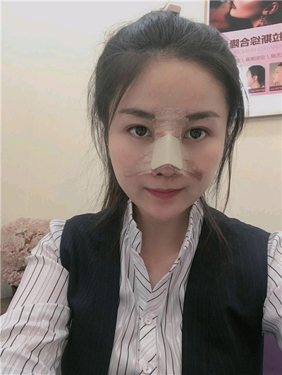 黑龙江超龙王海刚耳软骨隆鼻怎么样?好不好?案例分享