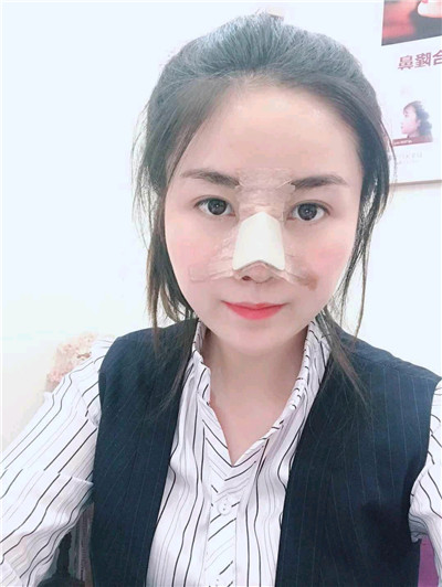 黑龙江超龙王海刚耳软骨隆鼻怎么样?好不好?案例分享