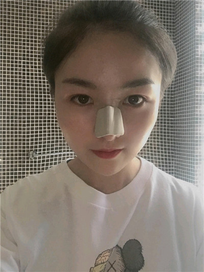 黑龙江超龙王海刚耳软骨隆鼻怎么样?好不好?案例分享