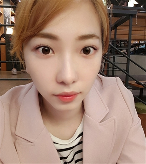 温州百佳东方整形孙华刚眼部手术怎么样?价格案