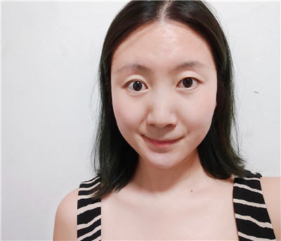 北京紫美韵郝创面部吸脂怎么样?好不好?案例分享