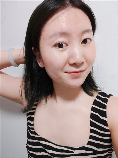 北京紫美韵郝创面部吸脂怎么样?好不好?案例分享