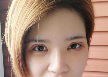 成都格莱丽石峰眼部修复怎么样?好不好?案例分享