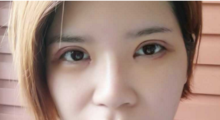 成都格莱丽石峰眼部修复怎么样?好不好?案例分享