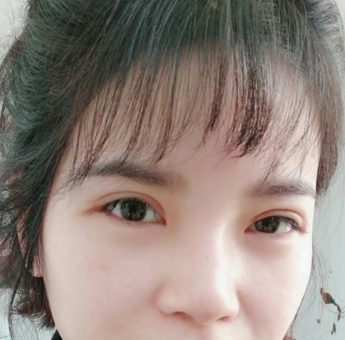 成都格莱丽石峰眼部修复怎么样?好不好?案例分享