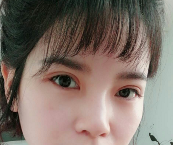 成都格莱丽石峰眼部修复怎么样?好不好?案例分享