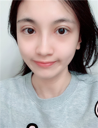 重庆百达丽黄伟光眼部综合怎么样?好不好?案例分享
