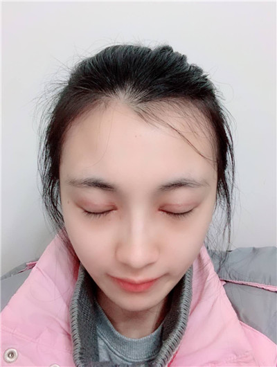 重庆百达丽黄伟光眼部综合怎么样?好不好?案例分享