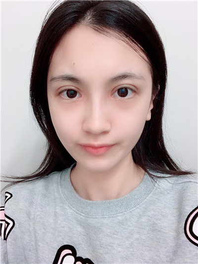 重庆百达丽黄伟光眼部综合怎么样?好不好?案例分享