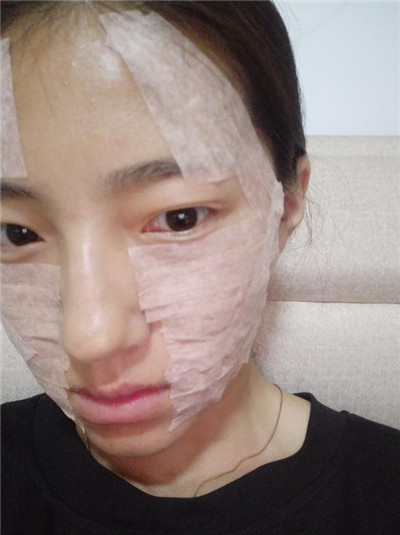 姜兆辉全脸填充怎么样?好不好?案例分享