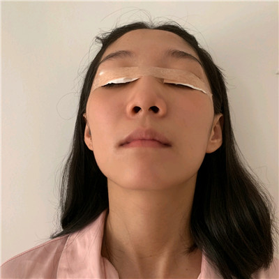 宁波唯格刘星宇眼部手术怎么样?好不好?案例分享
