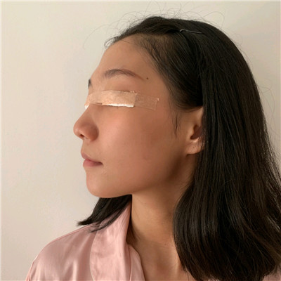 宁波唯格刘星宇眼部手术怎么样?好不好?案例分享