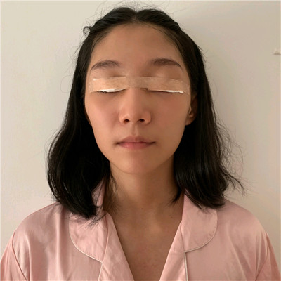 宁波唯格刘星宇眼部手术怎么样?好不好?案例分享