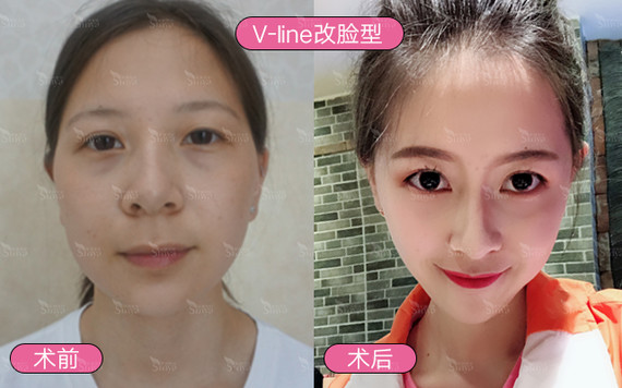 面部改善的顺序是怎么样的?果好不好?