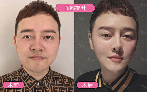 面部改善的顺序是怎么样的?果好不好?