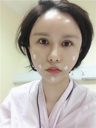 杭州维多利亚马腾面部填充怎么样?好不好?案例分享